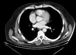 Bilateral Elastofibroma Dorsi Radiology Case Radiopaedia Org Radiology Case Rings For Men