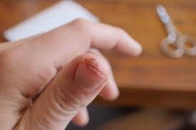 Image result for Akutní zánět nehtového lůžka