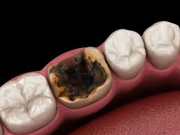 Image result for Tooth Extraction