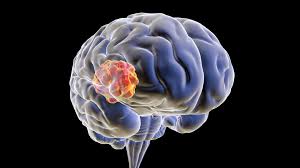 Image result for Brain Abscess