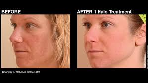 Images of chest and décolletage area, before and. What Makes Halo Hybrid Fractional Laser Different From Other Laser Treatments West Michgan Plastic Surgery Kalamazoo Mi West Michigan Plastic Surgery