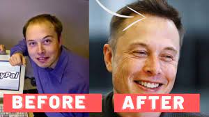 Maybe you would like to learn more about one of these? Inside Elon Musk S Hair Transformation How He Did It Hairguard