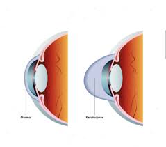 First because the amount of vision change needs to be measured, and an optomitrist or opthamologist are the ones with the right training and equipment to measure this change in 20/20 vision. Keratoconus Frequently Asked Questions Insight Vision Center Optometry