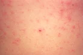 Image result for scabies bite