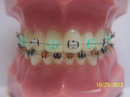 Black And White Braces Color Fashionable Braces General Dentist Orthodontics Braces Getting Braces Orthodontics Braces Braces