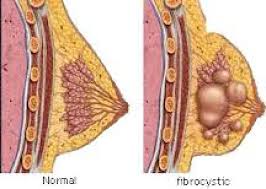 Fibrocystic breast changes (also called fibrosis or fibrocystic breast disease): Get Healthy Breasts Naturally New Therapy Minimizes Fibrocystic Breast Conditions By Reducing Cysts And Fibroids In Breast Tissue St Pete Fl Patch