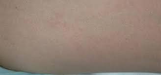 Image result for sweat rash on back