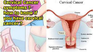 How often is it safe to douche? 7 Warning Symptoms Of Cervical Cancer That Every Women Should Know