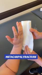 Image result for Ulnar Gutter Splint