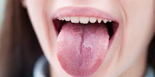 If you suspect you might have mouth cancer, schedule an appointment with your doctor or dentist. Why Is Your Tongue White Doctors Talk About The Causes