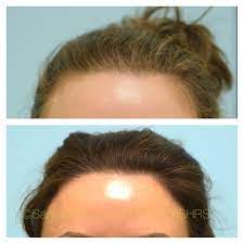This 44 Year Old Female Is Shown Before And One Year After A Female Hairline Lowering Hair Transplant Hair Transplant Hairline Transplant Hair Transplant Women