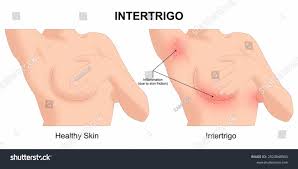 Image result for Intertrigo under breasts