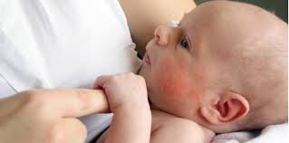 Panas pada bayi perlu diwaspadai jika anak mengalami tanda seperti muntah dan kejang saat demam. Betul Ke Gula Ada Kaitan Dengan Ekzema Pada Bayi Patutlah 3 Makanan Ini Jadi Pencetusnya Hello Doktor