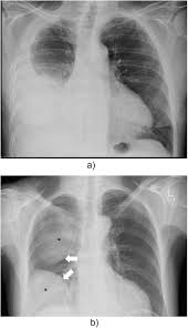 Learn about pleural effusion including causes of pleural effusion. State Of The Art Radiological Investigation Of Pleural Disease Sciencedirect