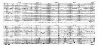 Image result for Late Deceleration