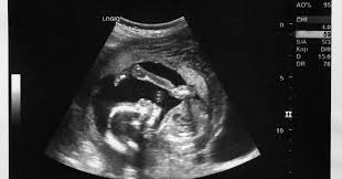 Image result for Ultrasound
