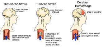 Types Of Stroke Chart Cerebrovascular Accident Nursing