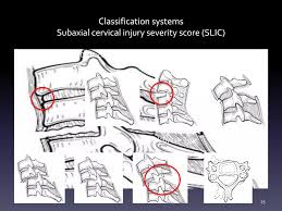 Image result for Subaxial Injury Classification Scale