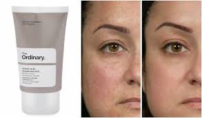 Azelaic acid is applied to your skin and is available in gel, foam, and cream form. Azelaic Acid Suspension 10 By The Ordinary