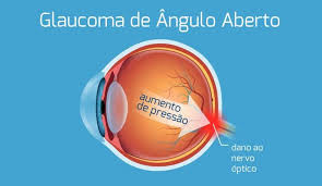 Listado de enfermedades de la a a la z. Glaucoma De Angulo Aberto O Que E Causas Sintomas E Tratamento Ioc