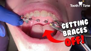 The damage you risk not seeing an orthodontist when it is only a quick thing to get braces and brackets removed to end treatment. Dental Braces How They Take Braces Off Tooth Time Family Dentistry New Braunfels Youtube