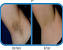 Hair Removal No No