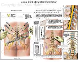 Pin On Spondylolisthesis