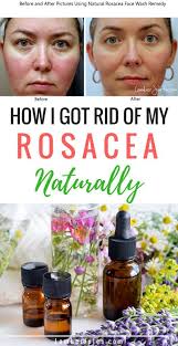 Rosacea Natural Remedy Natural Face Wash Rosacea Skin Care Natural Rosacea Treatment