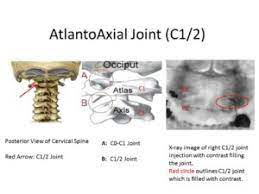 Eds Headaches Ehlers Danlos Syndrome Headaches Cci Instability