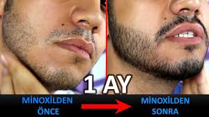 Çünkü sakal modası, bugünlük bu yüzyıllık bir şey değil. Minoxil 1 Aylik Kullanim Ve Yan Etkileri Sakal Cikartma Buyuk Degisim Youtube