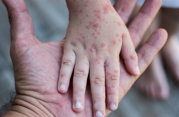 Da tay bị dị ứng nổi sần ngứa do đâu? Phongcachlamdep.com