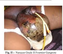 Maybe you would like to learn more about one of these? Pdf Original Article Narayan S Grading Of Fournier S Gangrene Semantic Scholar
