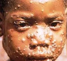 Akwa Ibom records fifth mpox case
