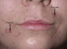 Maybe you would like to learn more about one of these? Image Acne Papules And Pustules Msd Manual Professional Edition