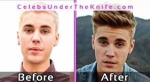 Justin Bieber Plastic Surgery Photos Before After Celebsundertheknife Celebs Celebrity Pla Plastic Surgery Photos Plastic Surgery Celebrity Plastic Surgery