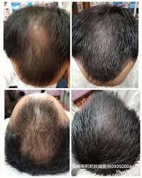 hairlines tattoo紋頭髮線改善地中海禿髮或高額頭 獨創利用手紋出一根一根仿真頭髮讓地中海頭部頭髮感覺自然變多免植髮 半永久紋髮際線 可維持3至5年 總店 台北板橋重慶路60號四樓之一近府中站 陳莉莉精緻紋繡藝術專業網站
