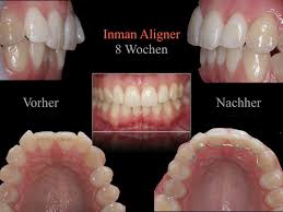 Kissdental is your trusted dentists in manchester that offers dental treatments including teeth implants, crowns, and cosmetic dentistry. Inman Aligner Lossburg Vorher Nachher Veranderung In 8 Wochen Dr Kasseckert Kasseckert