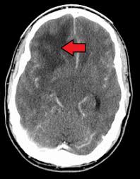 Common sites of metastasis the most common sites for cancers to metastasize include the brain, bones, lungs and liver. Glioblastoma Wikipedia