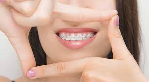 Harga pemasangan behel gigi lepas ini lebih murah dibandingkan behel permanen. Pasang Behel Permanen Untuk Merapikan Gigi Audy Dental