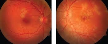 First described by gass in 1968, acute posterior multifocal placoid pigment epitheliopathy (apmppe) is an acquired inflammatory disorder affecting the retina, retinal pigment epithelium, and choroid of otherwise young healthy adults. A Rare Syndrome In Your Chair