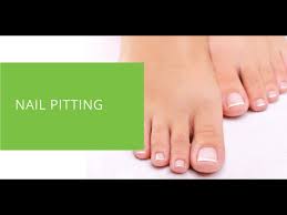 Image result for Pitting nails feet