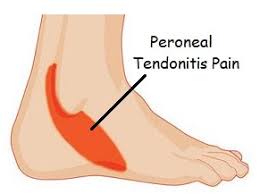 During that resting period, you should apply ice on your achilles tendon. Pain On Outside Of Foot Causes Symptoms Treatment