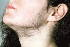 However, there are a number of ways you can remove unwanted hair. Diagnosis And Management Of Polycystic Ovary Syndrome