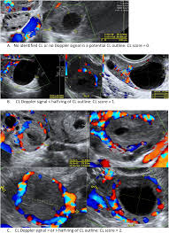 Image result for corpus luteum sonography)