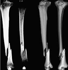 Each articulates with the zygomatic bone. Example Of 2d To 3d Registration The Fracture As Seen On The 2d X Rays Download Scientific Diagram