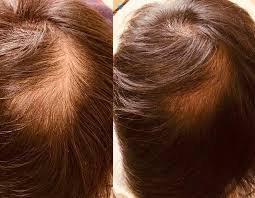 Alopecia areata occurs when your. Hair Loss Treatment Multicarenyc