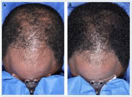 Help treat hair loss and regrow fuller hair with men's rogaine 5% minoxidil topical foam. Minoxidil Vs Male Pattern Baldness A Scientific Review