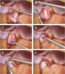 Image result for Purse String Suture