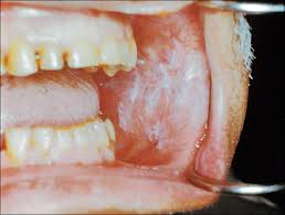 Rinse your mouth.if you need to use a corticosteroid inhaler, be sure to rinse your mouth with water or brush your teeth after taking your medication. White Oral Lesions How To Distinguish The Benign From The Deadly Consultant360