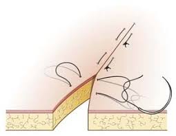 The advantages of the vertical mattress suture are that it provides closure for both deep and superficial layers, and also allows perfect eversion and vertical opposition of the superficial skin edges. Suture Techniques Used In Veterinary Surgery Boz Medical